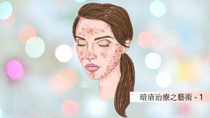 暗瘡治療之藝術 1 Blog.BeautyAademyHK.com